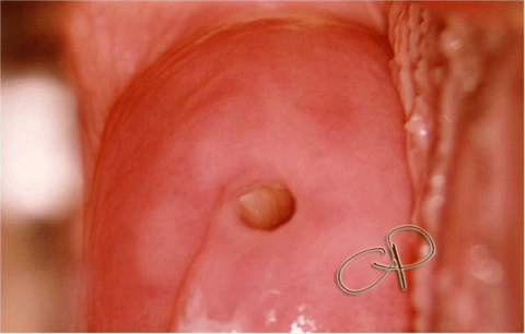 Portio normale con giunzione s.c. localizzata in corrispondenza
dellOUE e fuoriscita di muco cervicale 'a cascata'.