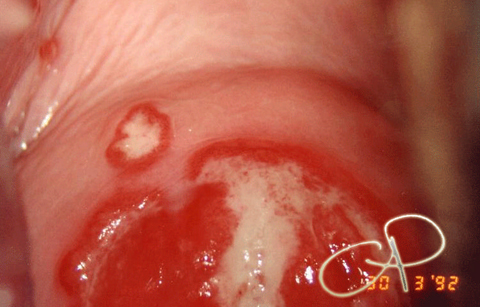 Herpes cervicale: zone biancastre a contorni irregolari