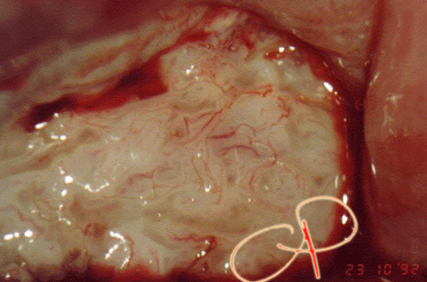 Carcinoma della portio: neoformazione rilevata di colore
bianco opaco con vasi atipici