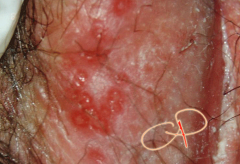 Herpes vulvare: 2 fase con molteplici ulcerazioni a fondo
giallastro circondate da una reazione eritematosa