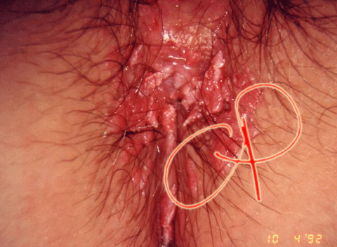 Condilomatosi florida della vulva e del perineo