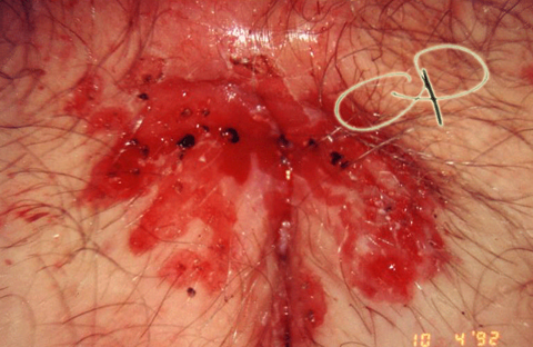 Vaporizzazione laser di estesa condilomatosi vulvare:
aspetto immediatamente dopo la fine del trattamento