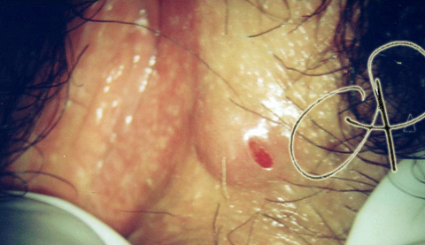 Idroadenoma papillifero: formazione rilevata a superficie ulcerata
