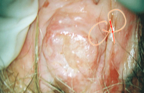 ca vulva: nodulo biancastro con vasi atipici