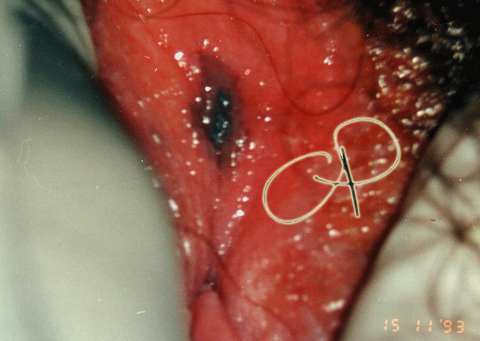 Melanoma della vulva
