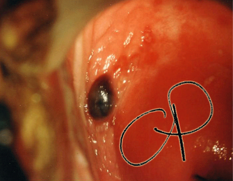Endometriosi della portio: presenza di formazione nodulare
rilevata rosso-bluastra